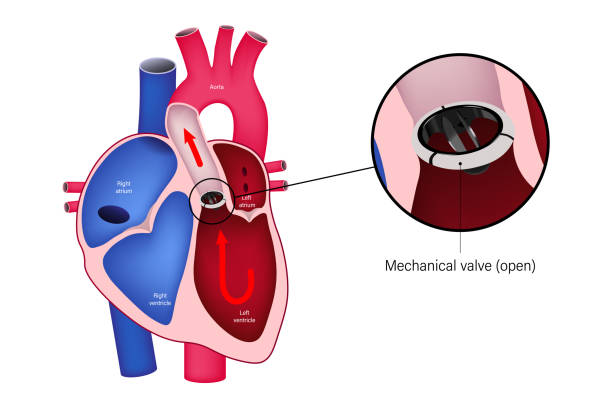 40 Heart Valve Replacement Stock Illustrations Royalty Free Vector 40 Heart Valve Replacement Stock Illustrations Royalty Free Vector
