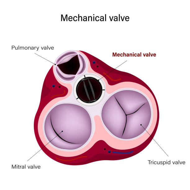 40 Heart Valve Replacement Stock Illustrations Royalty Free Vector 40 Heart Valve Replacement Stock Illustrations Royalty Free Vector