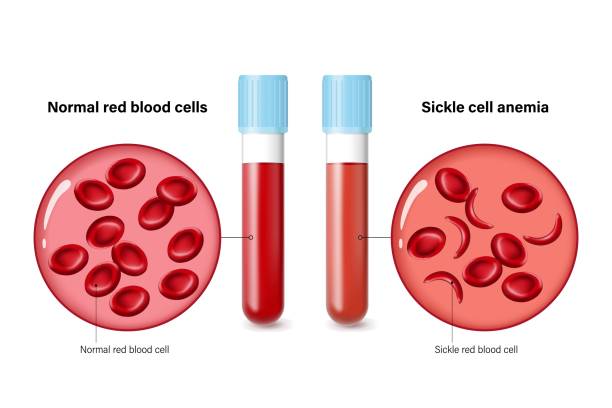 close up of normal red blood cells and sickle cell anemia. sickle cell disease. - sickle cell anemia red blood cell blood cell anemia stock-grafiken, -clipart, -cartoons und -symbole