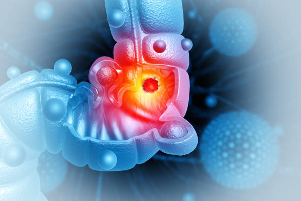 istock Colon cancer. Cancer attacking cell. Colon disease concept. 3d illustration 2135395686