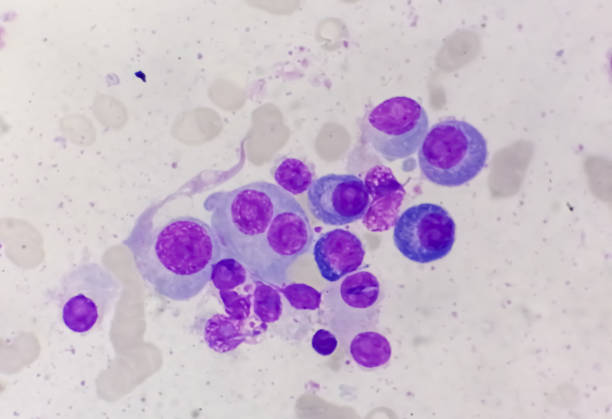 istock Bone marrow stained slide showing Multiple myeloma, also known as myeloma, is a type of bone marrow cancer. 2135643075