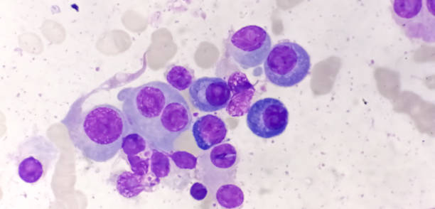 istock Bone marrow stained slide showing Multiple myeloma, also known as myeloma, is a type of bone marrow cancer. 2135643104