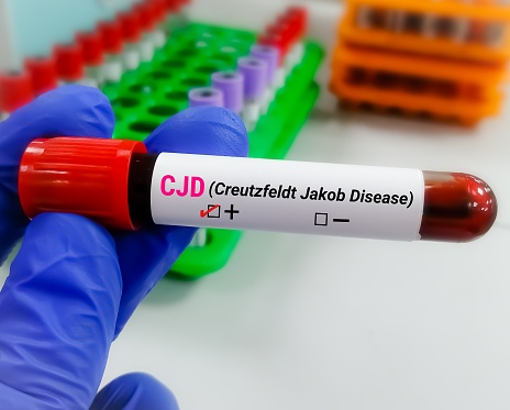 Creutzfeldt-Jakob disease (CJD) is a rare, rapidly worsening brain disorder that causes unique changes in brain tissue and affects muscle coordination thinking, and memory