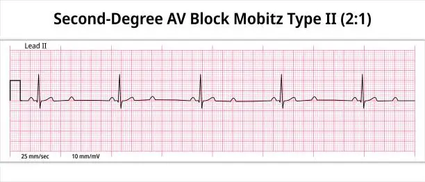 Vector illustration of ECG Second Degree AV Block Mobitz Type 2 (2:1) - 8 Sec Electrocardiogram