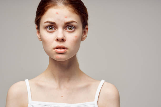 istock woman face skin problem acne acne portrait cropped view 2140607390