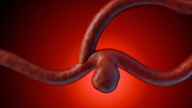 istock 3d rendering of an isolated saccular aneurysm 2142403343