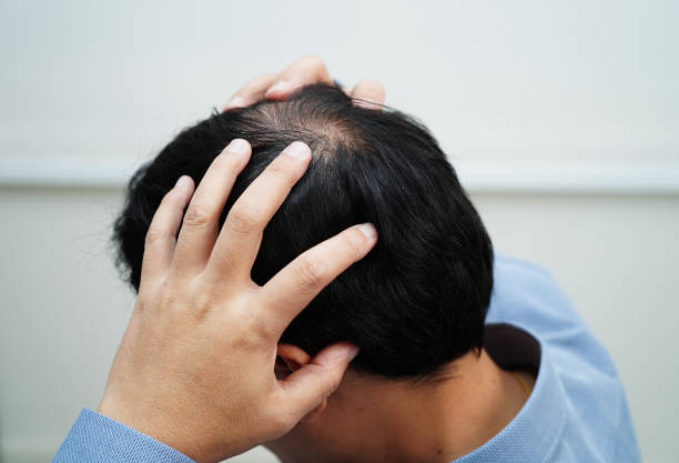 istock Bald head in man, hair loss treatment health problem. 2142797362