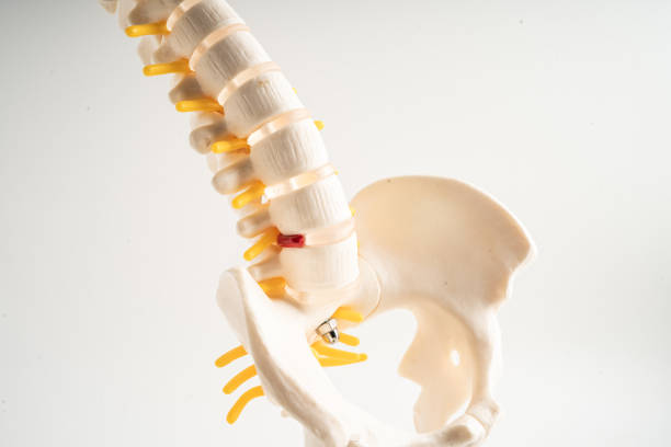 lumbar spine displaced herniated disc fragment, spinal nerve and bone. model for treatment medical in the orthopedic department. - slipped disc fotografías e imágenes de stock