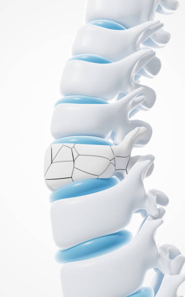 istock Models of human vertebrae and fractures, 3d rendering. 2148089834