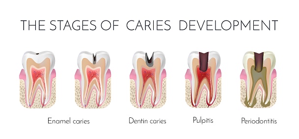 Tooth decay. The stages of caries development. Enamel and dentin caries, pulpits and periodontitis medical vector illustration