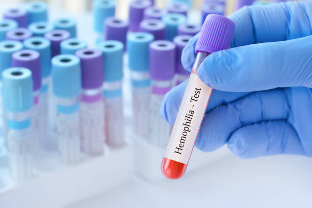 doctor holding a test blood sample tube with hemophilia test on the background of medical test tubes with analyzes. - blood red blood cell blood cell blood sample imagens e fotografias de stock