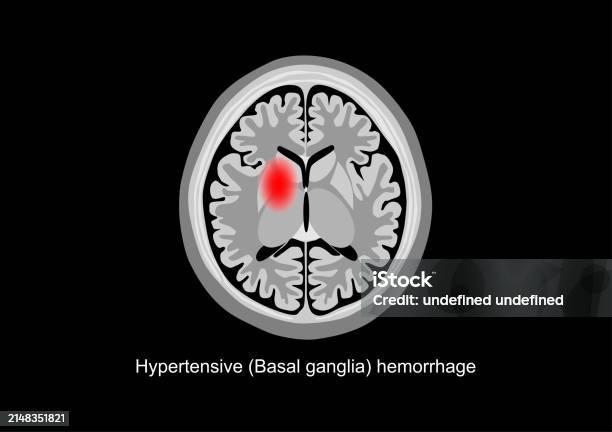 기저핵 출혈 뇌 스캔 그림 MRI 스캔에 대한 스톡 벡터 아트 및 기타 이미지 - MRI 스캔, CAT 스캔, 바닥핵 - iStock