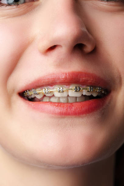 istock Young woman with dental braces close up 2148355596