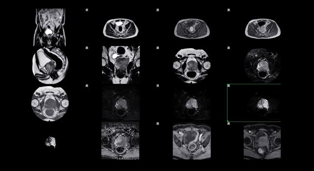MRI of the prostate gland reveals a focal abnormal signal intensity (SI).