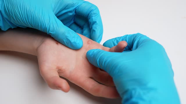 Dermatologist examines child hand, palm affected by viral flat warts Verruca vulgaris, close-up. Papillomavirus, HPV. Pediatric dermatology, skin diseases. Immunity reduction concept.