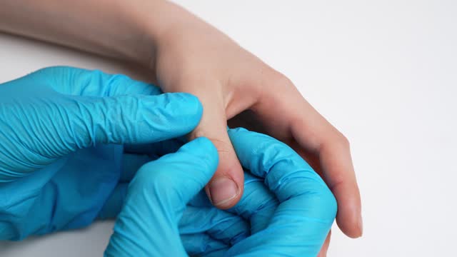 Doctor holds child hand with warts on thumb. Papillomavirus in child, close-up. Verruca vulgaris. HPV. Pediatric dermatology, diagnosis of nevus, benign neoplasms on human skin.