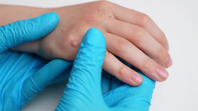 Doctor examines a child hand affected by viral warts Verruca vulgaris, close-up. Papillomavirus, HPV. Pediatric dermatology. Skin diseases