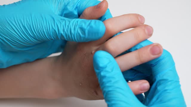 Dermatologist wearing medical gloves examines child hand with viral warts, thinks through course treatment,close-up. Verruca vulgaris, papillomavirus,HPV. Concept pediatric dermatology, skin diseases