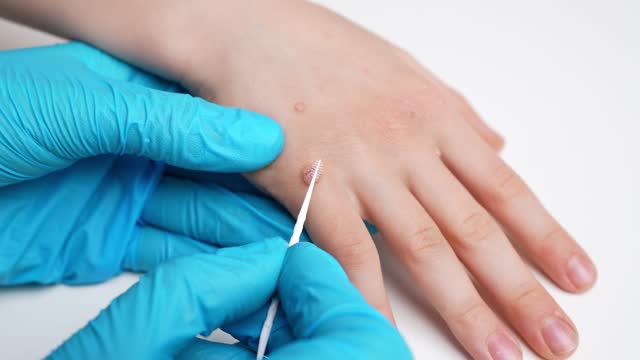 Doctor in blue gloves examines child hand affected by viral warts Verruca vulgaris and treats it with solution for warts, close-up. Papillomavirus,HPV. Concept of pediatric dermatology, skin diseases
