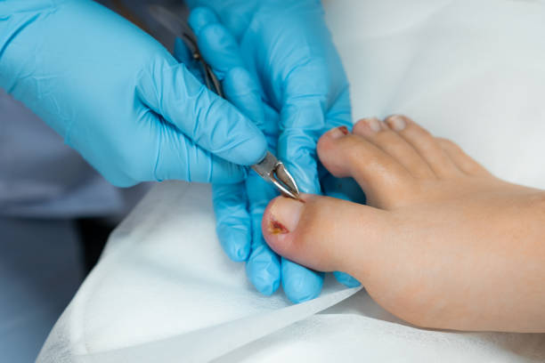 istock A podiatrist performs the procedure of ingrown nail removal using nippers 2148510928