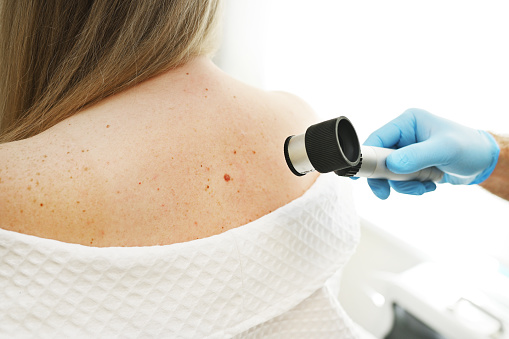 close-up - a dermatologist examines moles and skin growths on the patient's body using a special device - a dermatoscope. Diagnosis and prevention of melanoma.