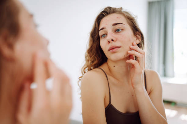 istock Beautiful young woman with problematic skin. 2148629107
