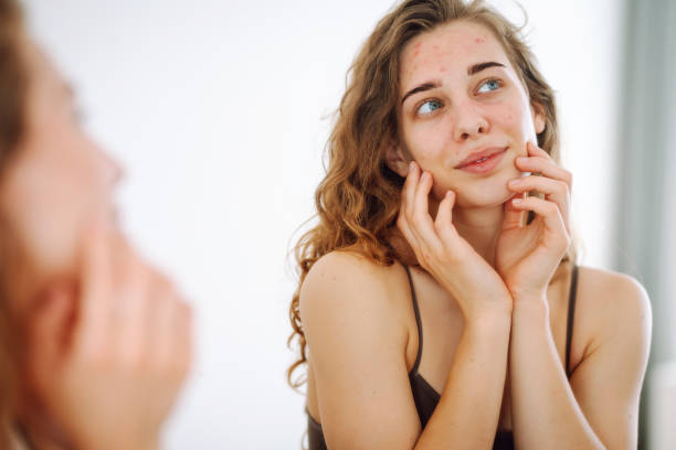 istock Beautiful young woman with problematic skin. 2148629116