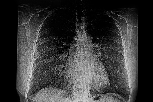 Medical Themes: Chest X-Ray of female patient