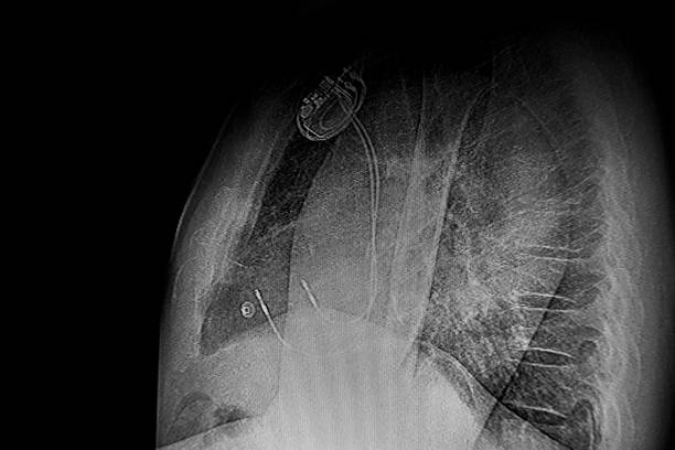 chest x- ray of a male patient with heart pacemaker - pacemaker torso chest male stock-fotos und bilder