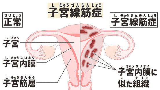 Adenomyosis labeled diagram; Normal and adenomyotic uterus