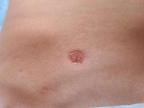 istock Close-Up of Persons Stomach With Spot 2148667271