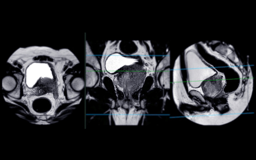 MRI of the prostate gland reveals a focal abnormal signal intensity (SI) lesion at the left posterolateral peripheral zones at the apex, aiding in diagnosing tumors and guiding treatment decisions.