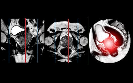 MRI of the prostate gland reveals a focal abnormal signal intensity (SI) lesion at the left posterolateral peripheral zones at the apex, aiding in diagnosing tumors and guiding treatment decisions.