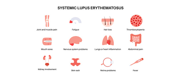 Systemic lupus erythematosus medical poster. Butterfly or malar rash on a female face. Autoimmune disease concept. Inflammation and skin tissue damage, pain in the internal organs vector illustration