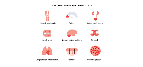 Systemic lupus erythematosus medical poster. Butterfly or malar rash on a female face. Autoimmune disease concept. Inflammation and skin tissue damage, pain in the internal organs vector illustration