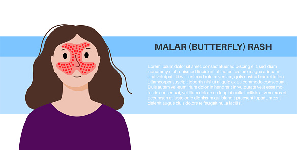 Systemic lupus erythematosus medical poster. Butterfly or malar rash on a female face. Autoimmune disease concept. Inflammation and skin tissue damage, pain in the internal organs vector illustration