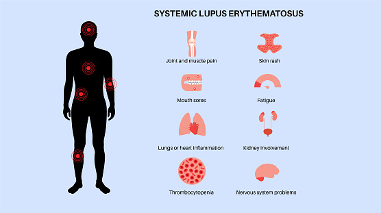 Systemic lupus erythematosus poster. Butterfly or malar rash, pain in the male body silhouette. Autoimmune disease concept. Inflammation skin tissue,  the internal organs   damage vector illustration