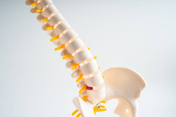 lumbar spine displaced herniated disc fragment, spinal nerve and bone. model for treatment medical in the orthopedic department. - slipped disc fotografías e imágenes de stock