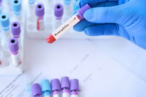 doctor holding a test blood sample tube with positive hemophilia test on the background of medical test tubes with analyzes. - blood red blood cell blood cell blood sample imagens e fotografias de stock