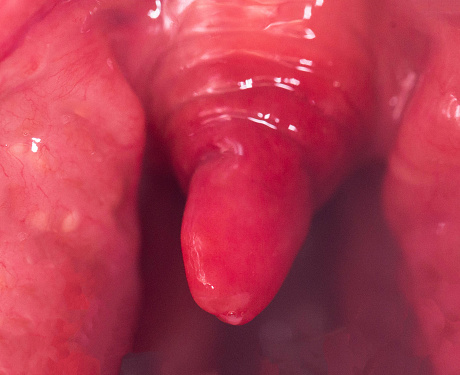 Long uvula with inflammation of infections and viruses. Treatment of uvulitis in children and adults. Sore throat, sore throat.