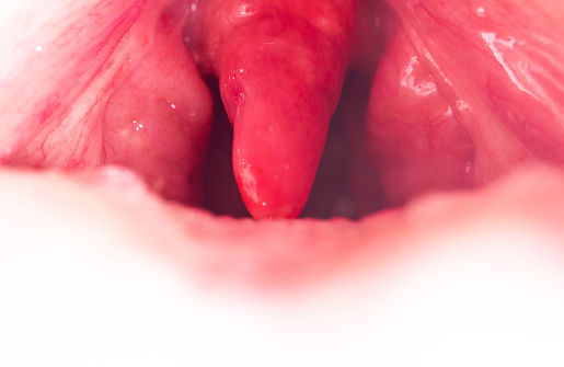 Long uvula with inflammation of infections and viruses. Treatment of uvulitis in children and adults. Sore throat, sore throat.