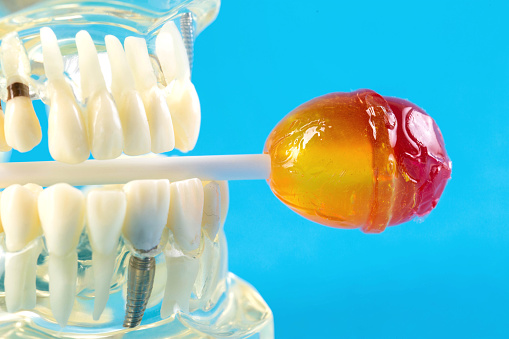 Candy on a stick in a tooth jaw mockup on a blue background. Concept of the effect of candies and sweets on the oral cavity and tooth enamel. Tooth destruction by sweet bacteria. Pulpitis and caries.
