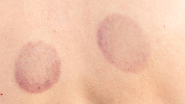 istock Traces from cans on human skin. Medicine 2148986355