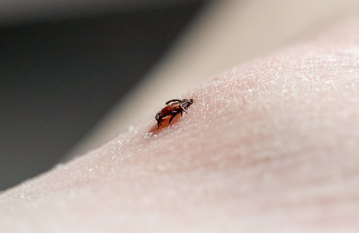 One small tick burrowed into the skin of a Caucasian man on the leg on a summer day, close-up side view.