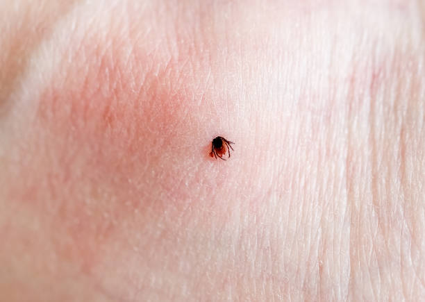 istock A tick embedded in a person skin. 2149013289