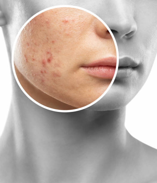 istock A young girl with a problem skin. Photo before and after treatment for acne. 2149016554