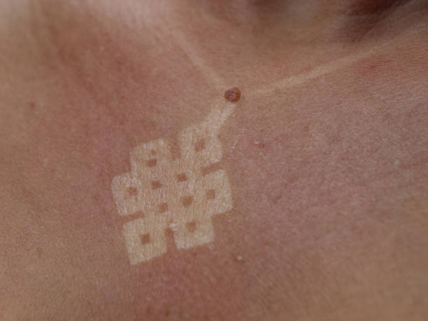 istock CLOSE UP, DOF: Unhealthy red burnt skin with visible white necklace pendant mark 2149024607