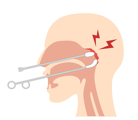 How to perform and illustrate Epipharyngeal Abrasive Therapy;B-spot therap