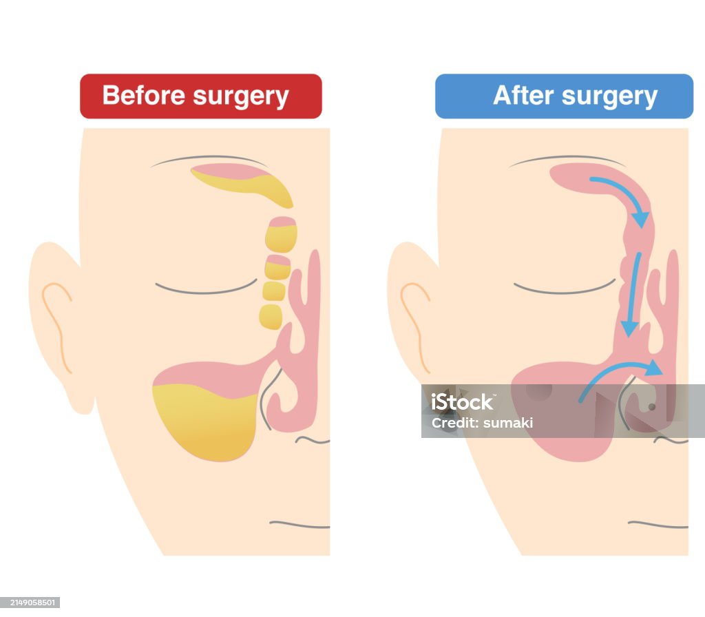 Ess Surgery Comparative Diagram Of How Endoscopic Sinus Surgeryess Is Performed Vs ...