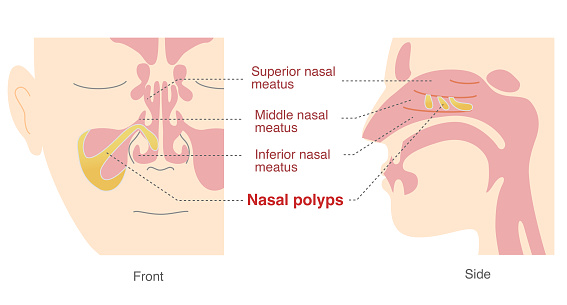 Illustration of nasal polyps in the sinuses from front and side views